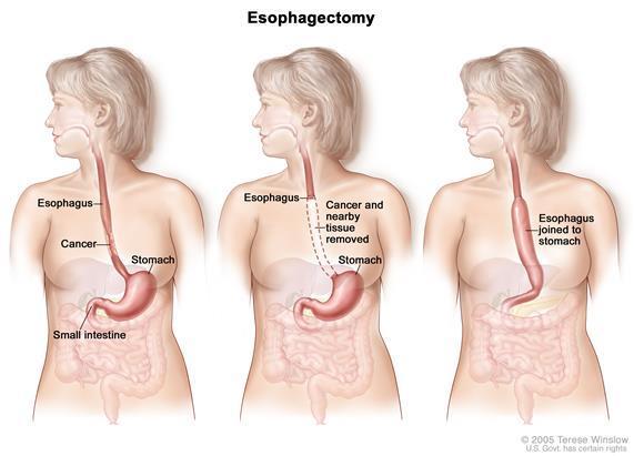 Esophagectomy Surgery Esophagectomy is surgery to remove part or all of the esophagus, lymph nodes, and nearby soft tissues. This is the most common procedure to treat esophageal cancer.