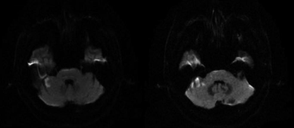 B E C Figure 1. MRI and audiovestibular findings in a patient with recurrent vertigo and fluctuating hearing loss with tinnitus prodromal signs of AICA territory infarction.
