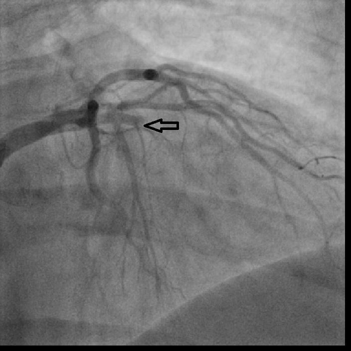 Immediate direct PCI was performed through the same catheter with initial predilatation with a 2.0 mm balloon.