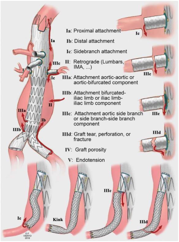 LONG-TERM COMPLICATIONS ENDOLEAKS = persistent flow of blood into the aneurysm sac after device placement Type I - incomplete seal at the proximal or distal attachment Type II - flow into and out of