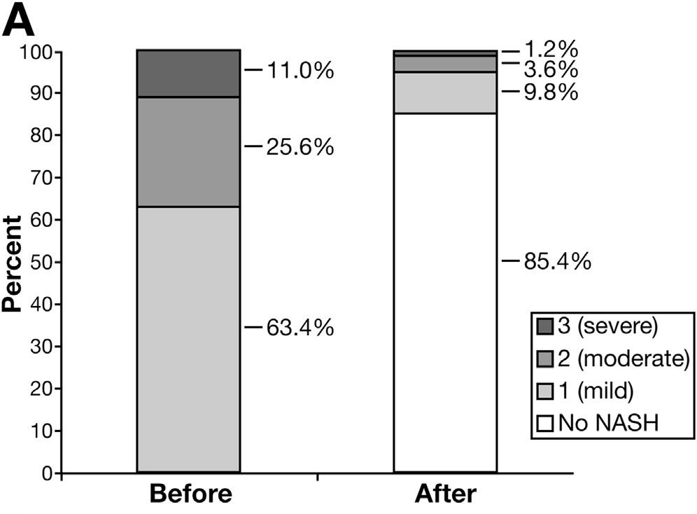 Effect of bariatric surgery in NASH (n=109) NASH Fibrosis