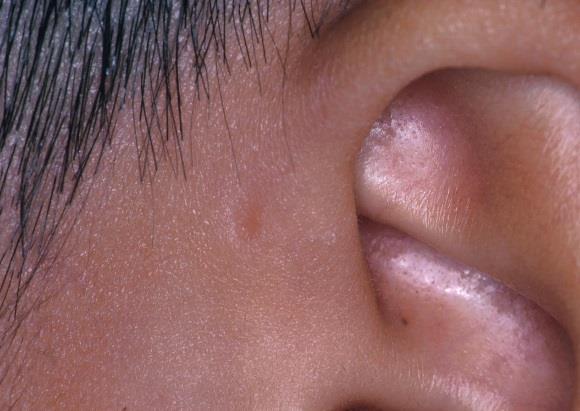 Pre-auricular Pits & Sinuses Ectodermal inclusions Stratified