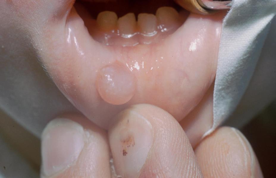 Mucous retention cyst Usually inside lower lip May be traumatised by biting Often