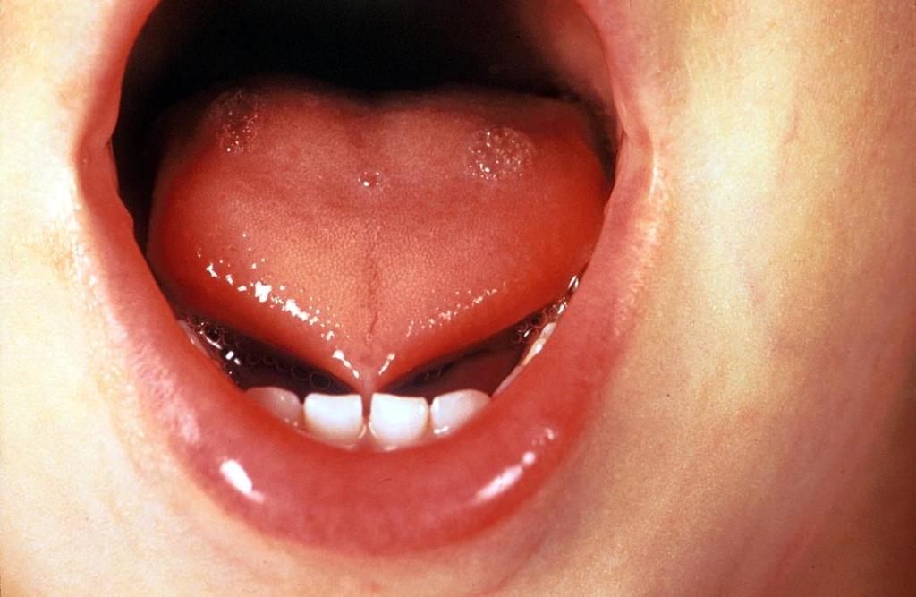 Tongue tie Does not interfere with swallowing May affect pronunciation of some consonants No other