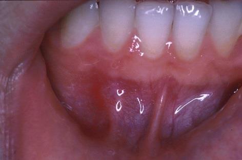 Submental lymphadenopathy More anterior than thyroglossal cyst May be multiple nodes Look for
