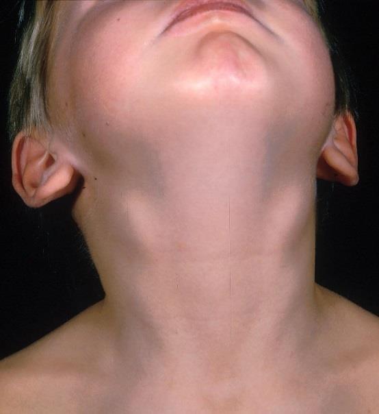 Lateral neck lumps in children Lymph nodes reactive hyperplasia