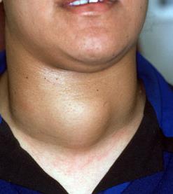 Anterior neck Slightly lateral to midline Rises with swallow May be multiple/ bilateral May be