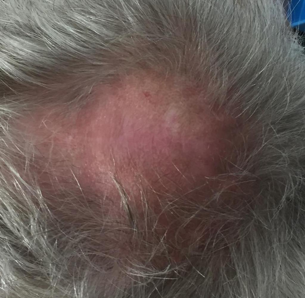 Case 7 71 yr old man Biopsy proven SCC scalp Excised March 2016 Poorly