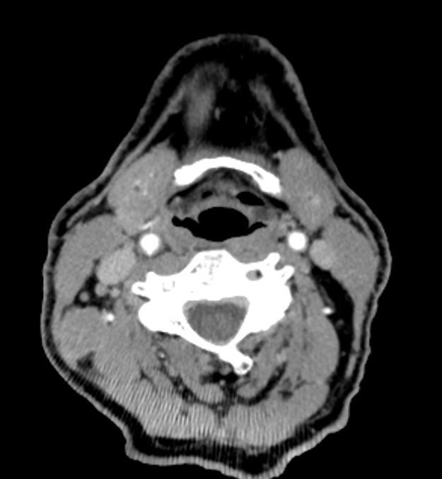 Case 7 FNA = malignant cells suggestive of SCC CT= multiple level 5a