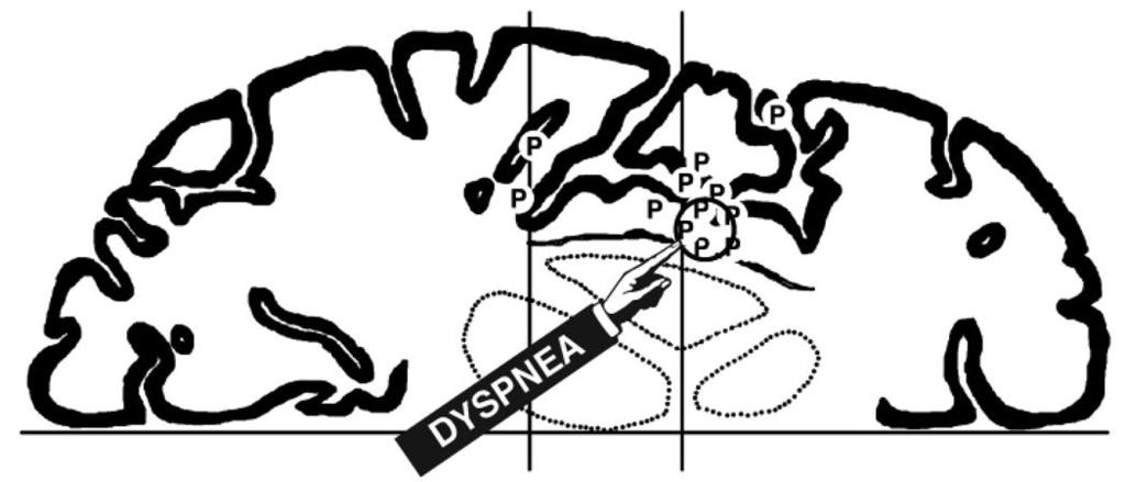 Neuropsychological Components of Dyspnea Pain and Dyspnea in the Anterior Insula. One of the key brain regions activated in both dyspnea and pain is the anterior insula.