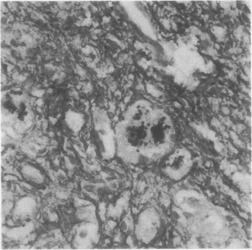 20 Fig. 2 Alcoholic cirrhosis. A few hepatocytes loaded with copper-associated protein are deeply enmeshed within fibrous tissue. Orcein x 320 /.2 ;::. : -.:it :: *:.