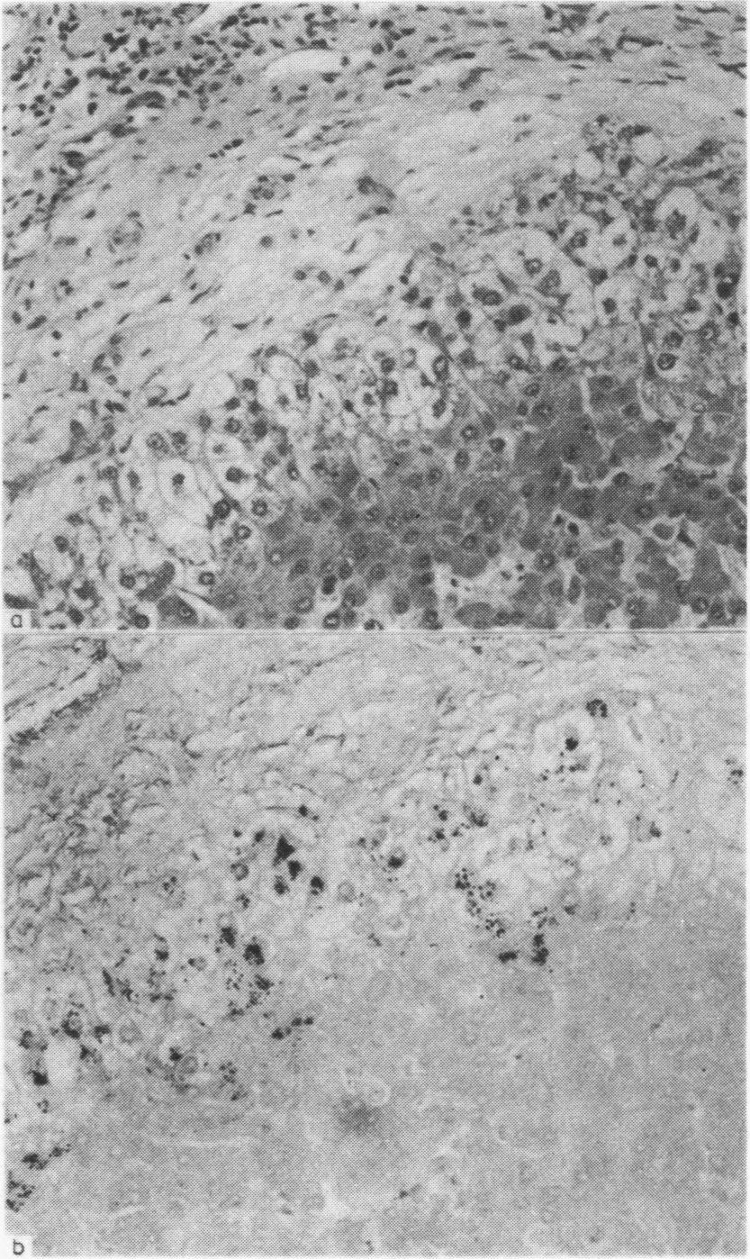 Value of copper-associated protein in diagnostic assessment of liver biopsy Table 2 protein Conditions not associated with copper-associated No of biopsies Acute cholangitis 8 Acute cholestasis 7