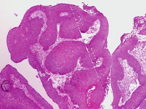 The epithelium shows maturation with no marked cytologic atypia. Fig. 2.