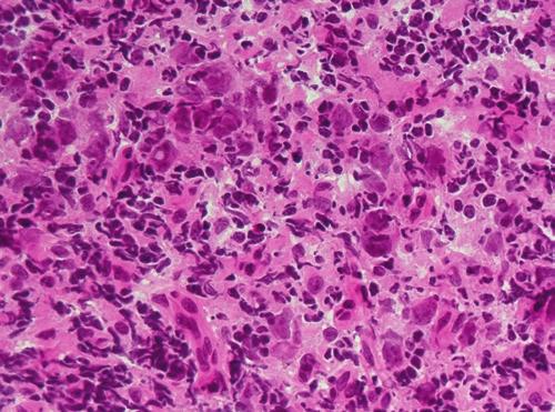 Nasopharyn geal carcinoma, islands of tumor cells intimately admixed with lymphocytes and plasma cells.