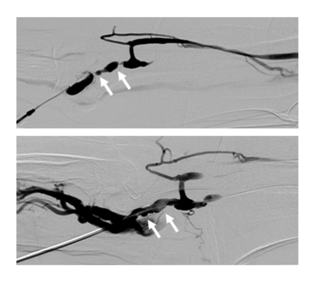 Fig. 1: Multiple venous stenosis before and after PTA.