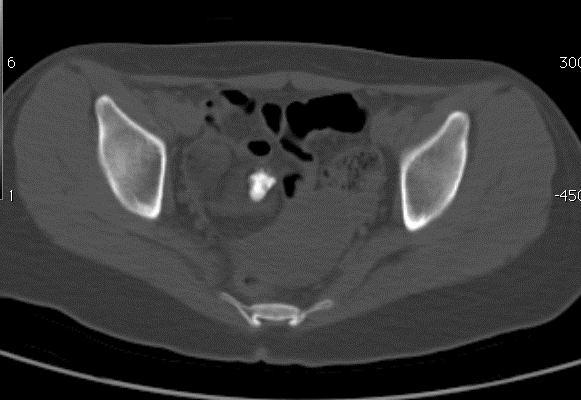 heterogeneous ovoid mass in the right pelvis, which had some tooth-like