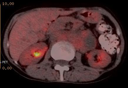 PET/CT findings No significant FDG uptake in the