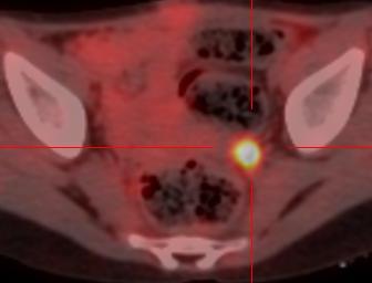 shows peritoneal nodules in