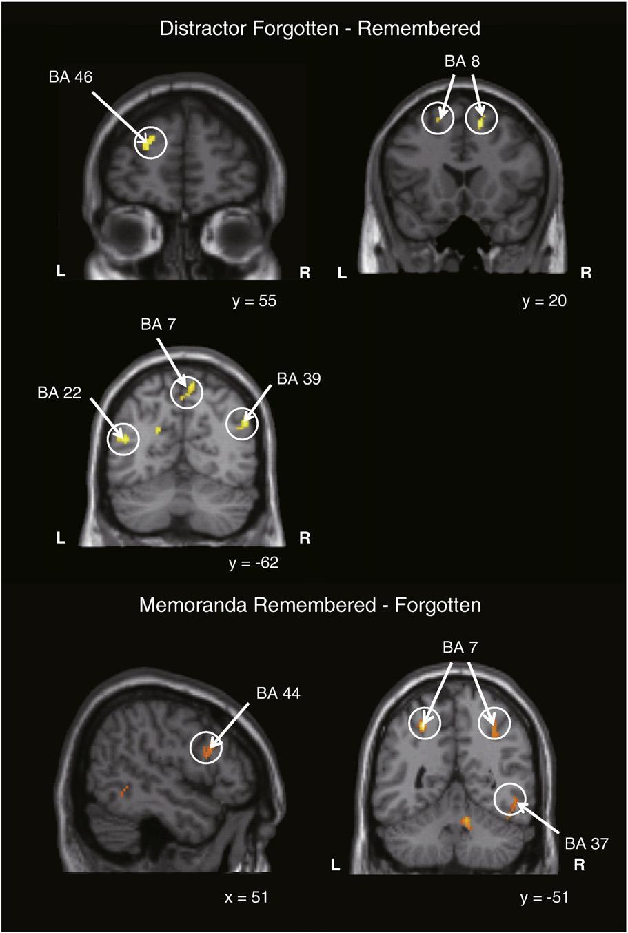 87 Fig. 4 Brain activation maps based on the subsequent memory performance.
