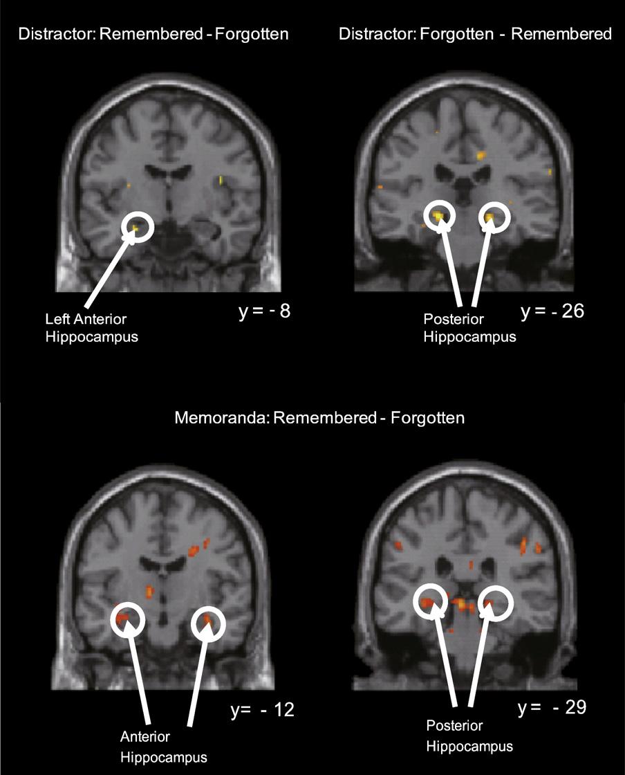 90 BRAIN RESEARCH 1429 (2012) 82 97 Fig. 6 Activation in the hippocampal area during presentation of distractors.