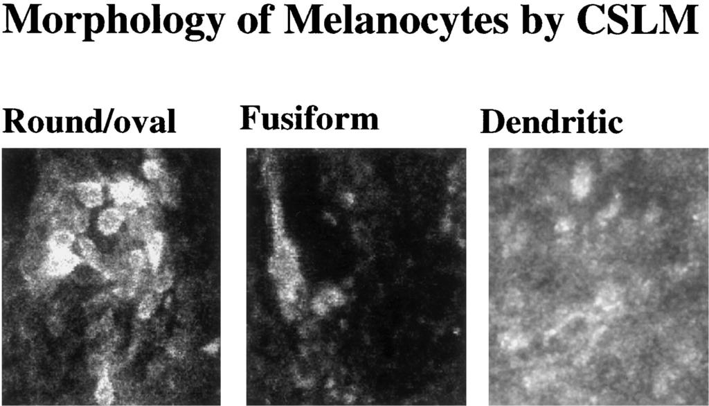 FIGURE 2. Keratinocytes and melanophages in a pigmented seborrheic keratosis.