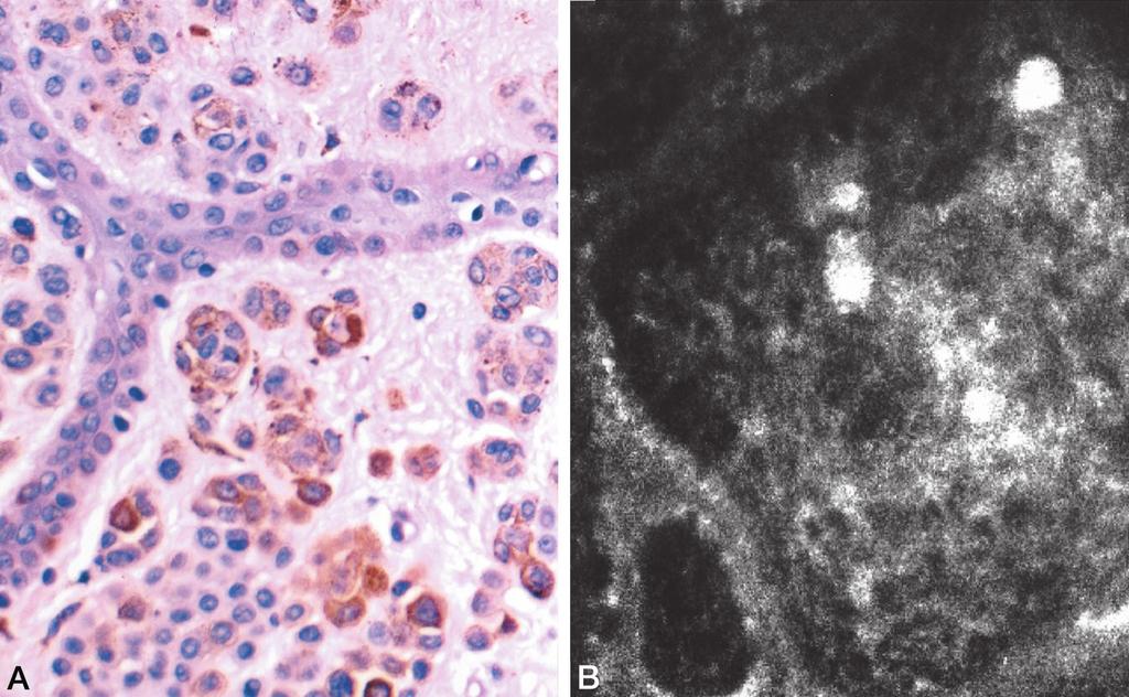 FIGURE 4. Compound melanocytic nevus. A, hematoxylin and eosin stained section shown in horizontal plane at the level of the dermoepidermal junction and superficial dermis.