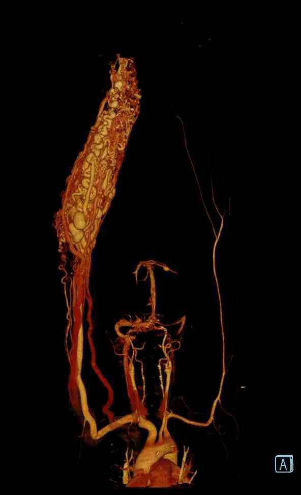 vascular structure,arterial blood