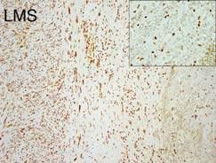 spindle, fascicular growth) compatible IHC Brigham/Schaefer *MPNST Tier 1 / Tier 2 based on the