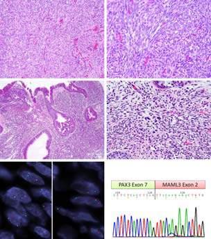 PAX3 MAML3 Biphenotypic Sinonasal Sarcoma monomorphic spindle cell tumor with dual neural and myogenic phenotypes PAX3 NCOA1 variant Biphenotypic Sinonasal Sarcoma IHC: S100 + Actin pos; SOX10 neg