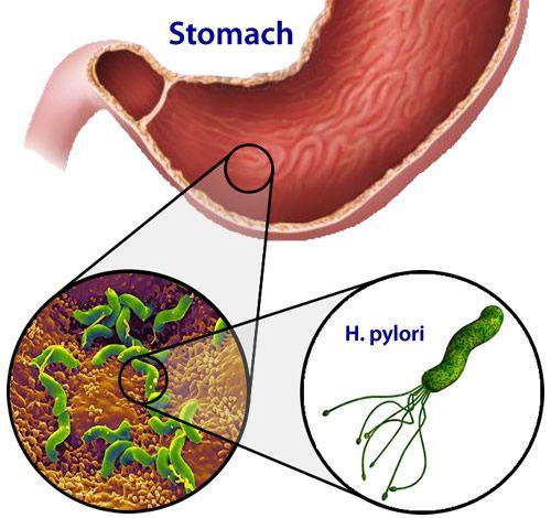 Helicobacter pylori Look up: Class of drugs used: http://www.webmd.