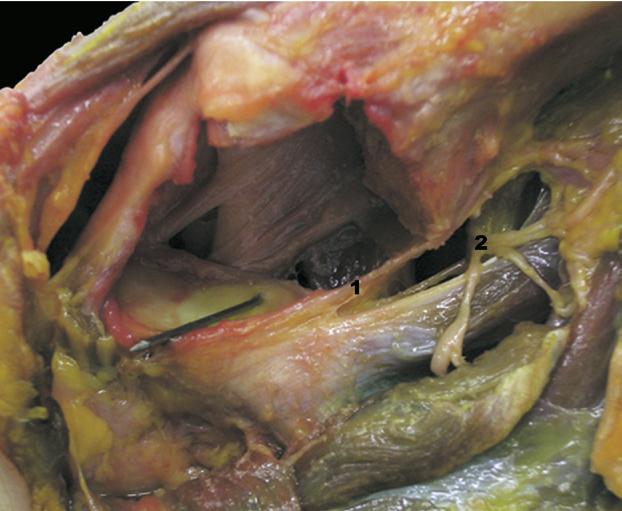 526 P. E. GELBER ET AL. FIGURE 6. Posterior view of the right shoulder in the LDP. The terminal branches of the axillary nerve are seen passing to the posteroinferior aspect of the glenohumeral joint.