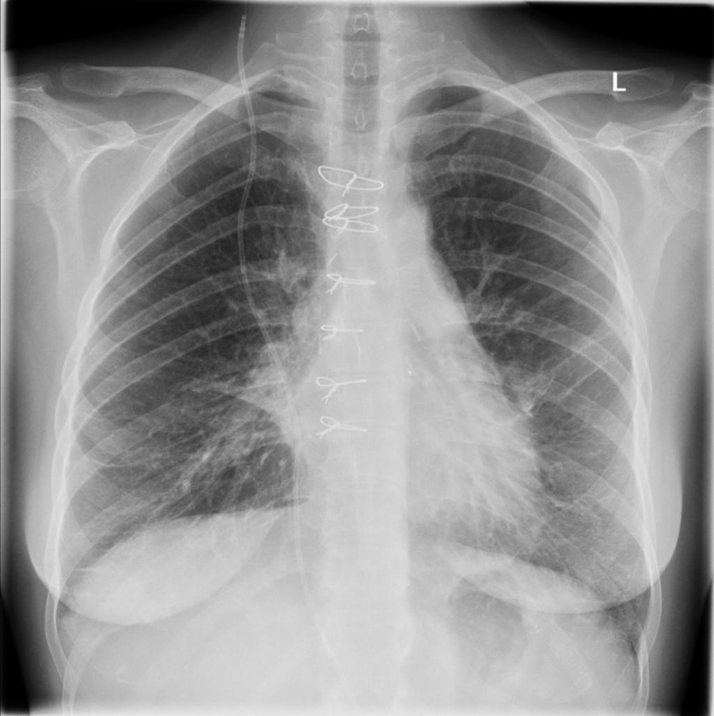 Fig. 2: Chest X-ray in a patient who received multiple follow-up studies due to