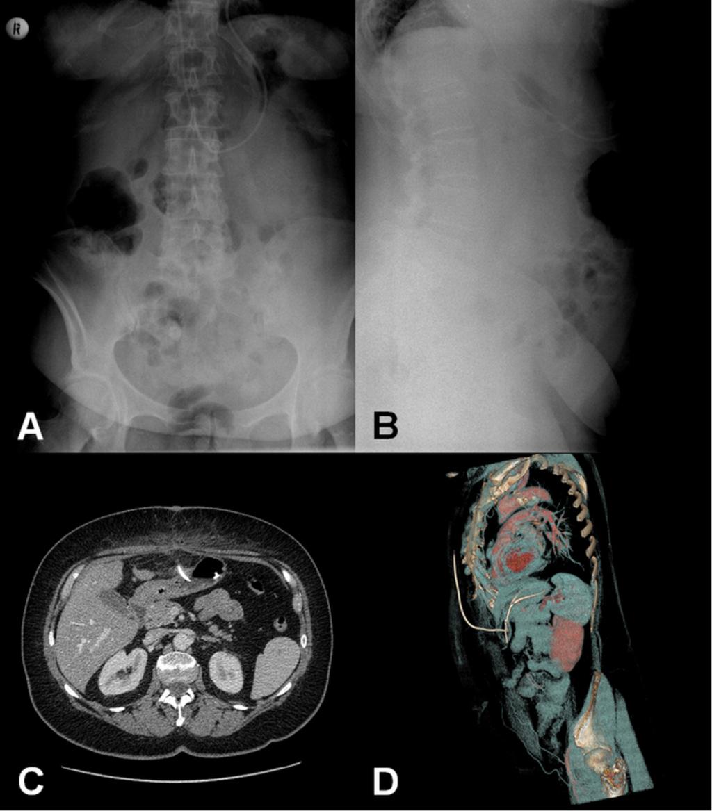 Fig. 5: Abdominal x-rays show an atypical position of the abdominal catheter.