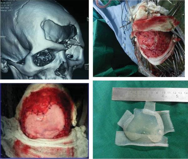 82 Management Strategies for Communited Fractures of Frontal Skull Base Velho et al. was exteriorized with pericranium after removal of mucosa and irrigation with antibiotic solution.