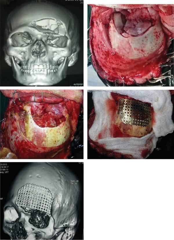 Management Strategies for Communited Fractures of Frontal Skull Base Velho et al. 83 Fig. 3 Cranioplasty using titanium mesh implant. specific fractures.