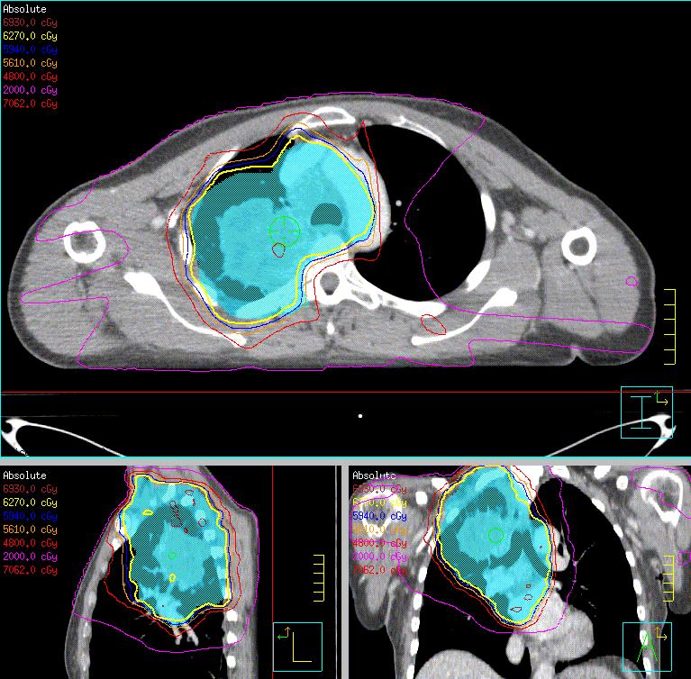 Intensity modulated radiotherapy V20 33.1% MLD 19.4Gy Max SC 47.