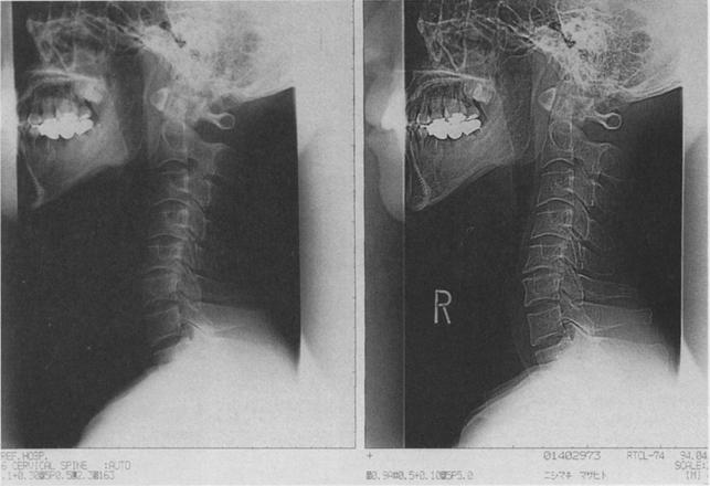 52 FUJITA ET AL ; 4q;. ~Z:. ::.i~?! :'i. [~5i:, Fig 1. An x-ray film of the 14c~ '~'~~ ::Lv4 ~,!~i~~ cervical spine processed at Osaka,~ '~Lt Prefectural Hospital.