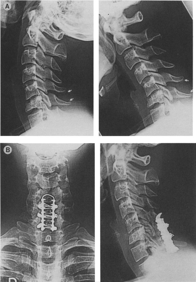 ADVANTAGES AND DISADVANTAGES OF CR IMAGE 53 Fig 3. Case 1: Lateral view of a C6 body fracture (A). Posterior spinal fusion with bone grafting osing Alligator plate was performed (B).
