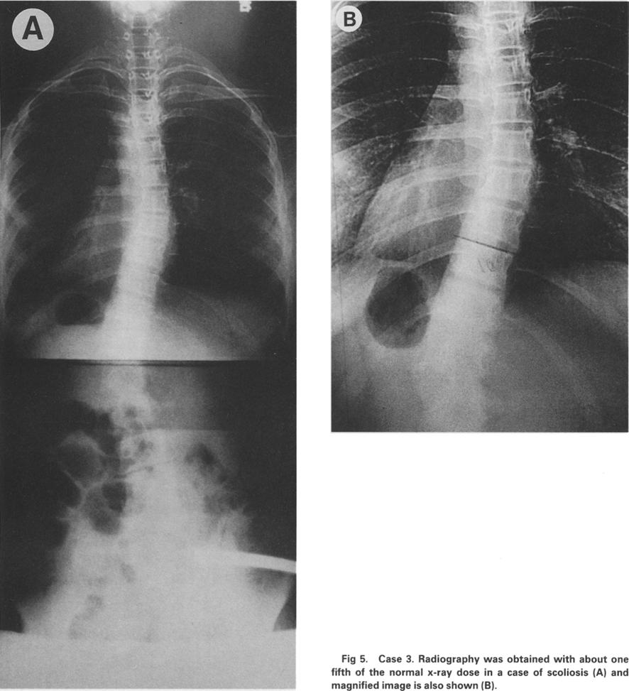 ADVANTAGES AND DISADVANTAGES OF CR IMAGE 55 Fig 5. Case 3. Radiography was obtained with about one fifth of the normal x-ray dose in a case of scoliosis (A) and magnified image is also shown (B).