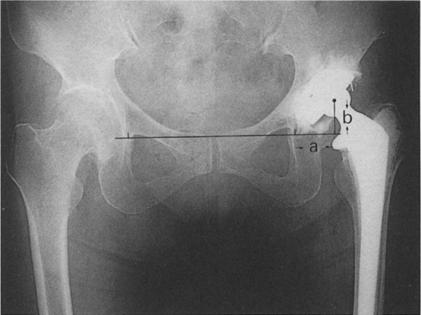 in the region of interest (RO1). The total x-ray exposure dose is 35 ~Sv. This is about one half of the usual x-ray dose for a lateral view of the calcaneus.