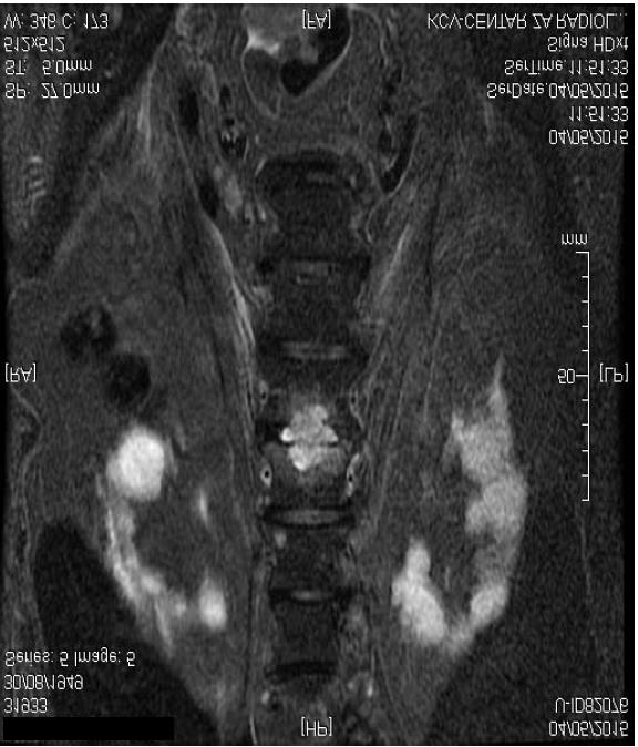 KOMPLIKACIJE KATETER-VEZANIH INFEKCIJA KOD BOLESNIKA NA HEMODIJALIZI VL2-3 pršljenova MR pregledom L-S kičme (slika 2) i pozitivne hemokulture kojima je izolovan Slika 2: Magnetna rezonanca pregled