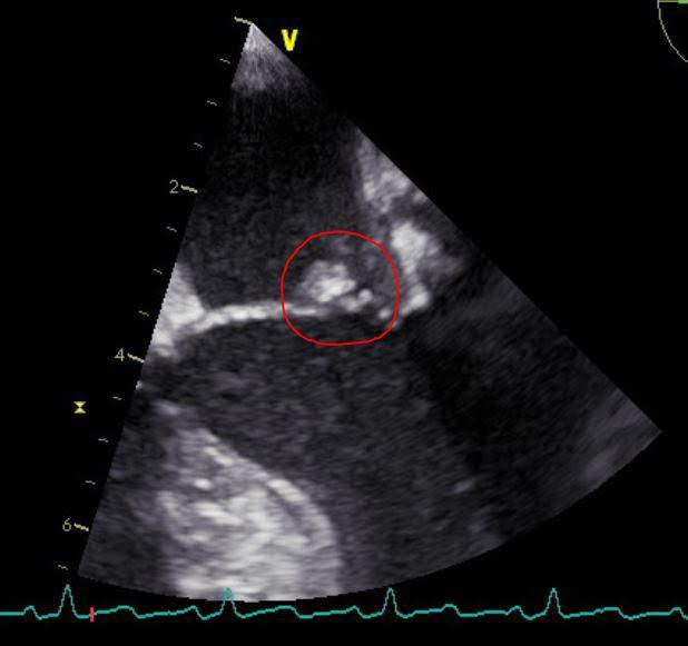 90 SJAIT 2017/1-2 Slika 4: Transezofagealni ultrazvuk - vegetacije na mitralnoj valvuli kompresivne frakture oba pršljenska tela (slika 3).