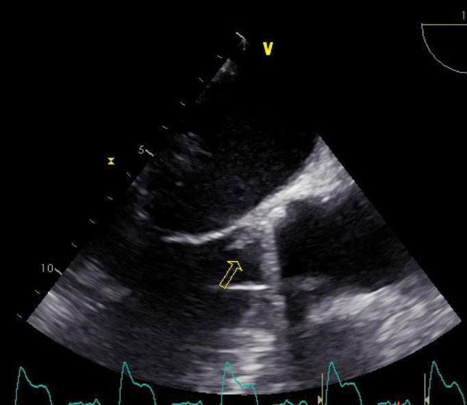 KOMPLIKACIJE KATETER-VEZANIH INFEKCIJA KOD BOLESNIKA NA HEMODIJALIZI Slika 5: Transezofagealni ultrazvuk - vegetacija na vestačkoj aortnoj valvuli Diskusija: Incidencija spondilodiscitisa je veća kod