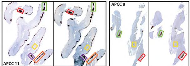 Pathogenesis of PA: APCCs Pathogenesis of PA: APCCs APCCs -Increase With Age