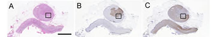 Nanba 2016 J Clin Endocrinol Metab 101:999 Imaged Tumor Not Source of Aldo