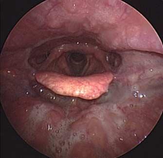 endoscopic photographs taken with the tongue protruded: grade 0, no tonsils; grade 1, spotted tonsil tissues with the tongue base vasculature visible; grade 2, diffuse tonsil tissues with the tongue