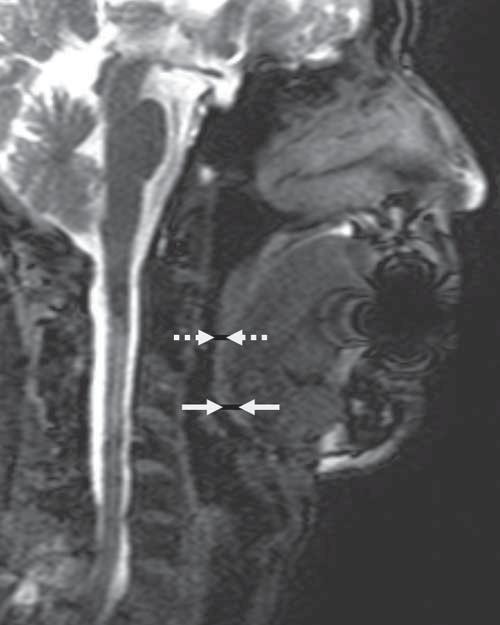 A B Figure 2. Magnetic resonance imaging. Magnetic resonance images in 2 patients with prominent lingual tonsils (A) and scanty lingual tonsils (B).
