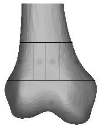 The model of the femur with locking plate and tibia is shown in Figure 5. packages (Version 2010; Mahidol University; Nakhon Pathom, Thailand).