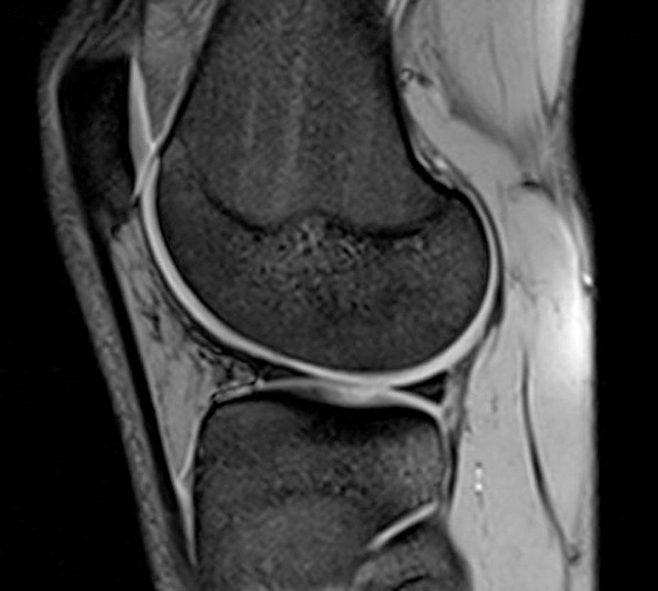 Arthroscopic verification of objectivity of the orthopaedic examination and magnetic resonance imaging in intra-articular knee injury. Retrospective study Figure 5.