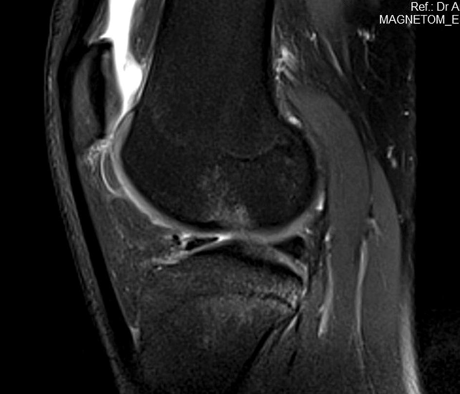 De Smet et al. [11] stated that it is connected with more frequent lesions of the posterior horn of the meniscus or only 1/3 of the meniscus torn back, which is more difficult in diagnostics.